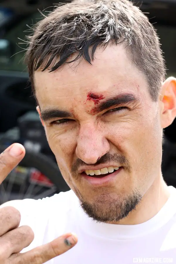 The course took its toll, giving this Cat 4 racer some battle scars after he collided with a racer who crashed in front of him. © Cyclocross Magazine