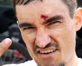 The course took its toll, giving this Cat 4 racer some battle scars after he collided with a racer who crashed in front of him. © Cyclocross Magazine