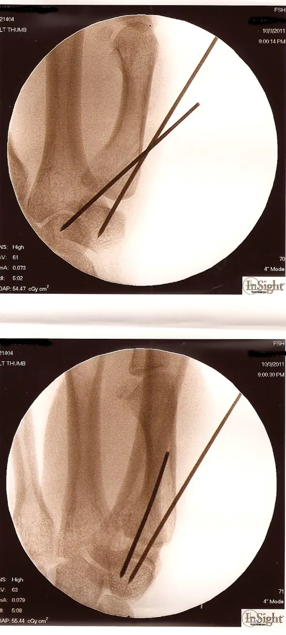 Mark's thumb after surgery.