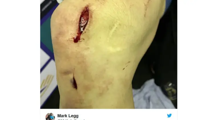 Katie Compton cut by a disc brake rotor in Lille. photo: Mark Legg Compton